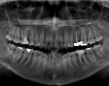 Panoramik - Sefalometrik Dental Röntgen